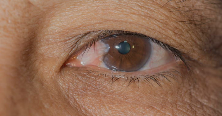 Cornea / External Diseases - Eye Centers of South Florida